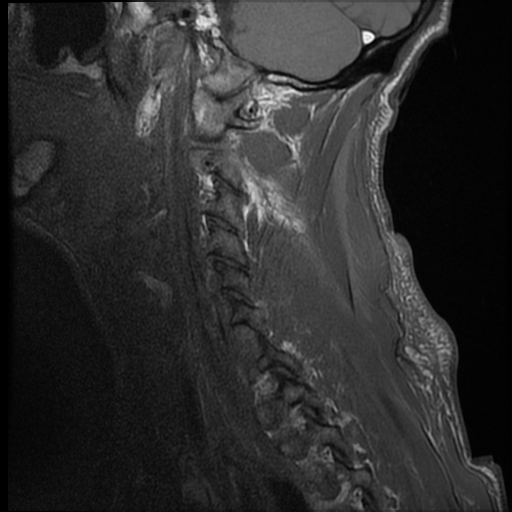 File:Bilateral perched facets with cord injury (Radiopaedia 45587-49714 Sagittal T1 1).jpg