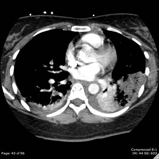 Bilateral pulmonary emboli with Hampton hump sign (Radiopaedia 54070-60246 Axial C+ CTPA 40).jpg