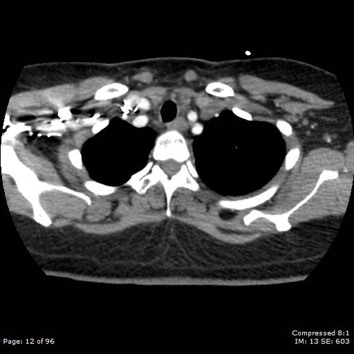 Bilateral pulmonary emboli with Hampton hump sign (Radiopaedia 54070-60246 Axial C+ CTPA 9).jpg