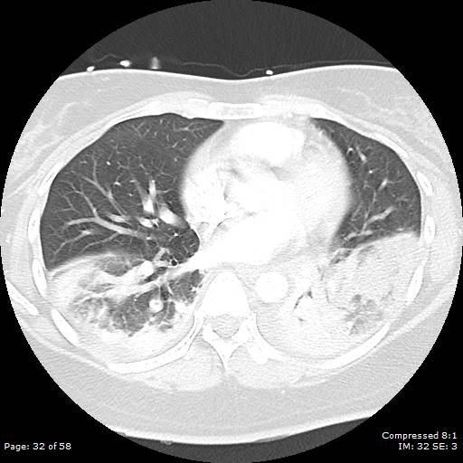 Bilateral pulmonary emboli with Hampton hump sign (Radiopaedia 54070-60246 Axial lung window 32).jpg