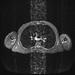 File:Bilateral spinoglenoid notch ganglion cysts (Radiopaedia 29577-30082 E 19).jpg