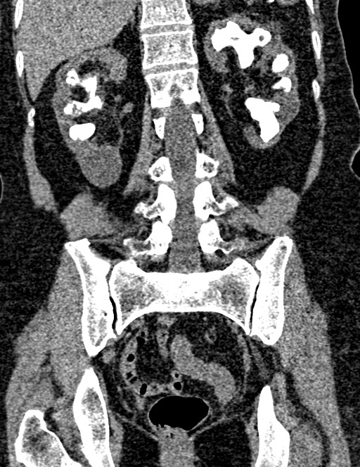 Bilateral staghorn calculi (Radiopaedia 59475-66842 Coronal non-contrast 72).jpg