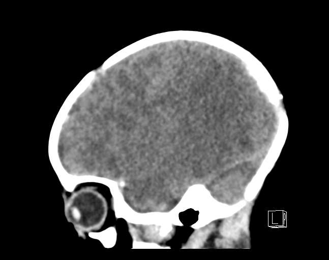 File:Bilateral subdural hemorrhage and parietal skull fracture (Radiopaedia 26058-26192 C 6).png