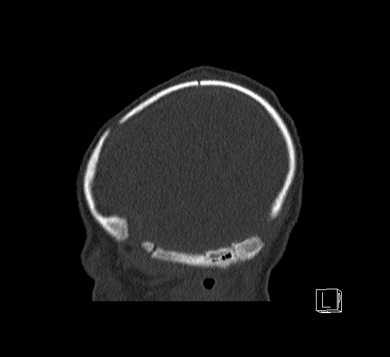 Bilateral subdural hemorrhage and parietal skull fracture (Radiopaedia 26058-26192 Sagittal bone window 84).png