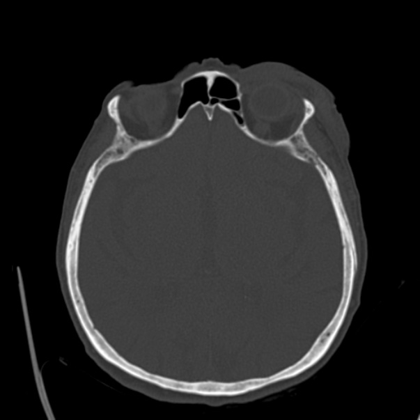 Biparietal osteodystrophy (Radiopaedia 46109-50463 bone window 34).jpg