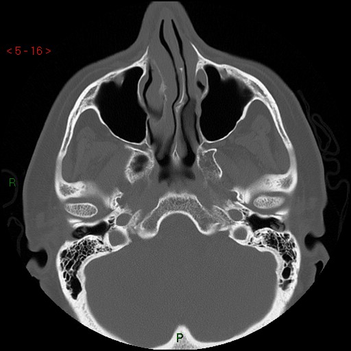 Bisphosphonate-related osteonecrosis of the jaw (Radiopaedia 54147-60329 Axial bone window 10).jpg