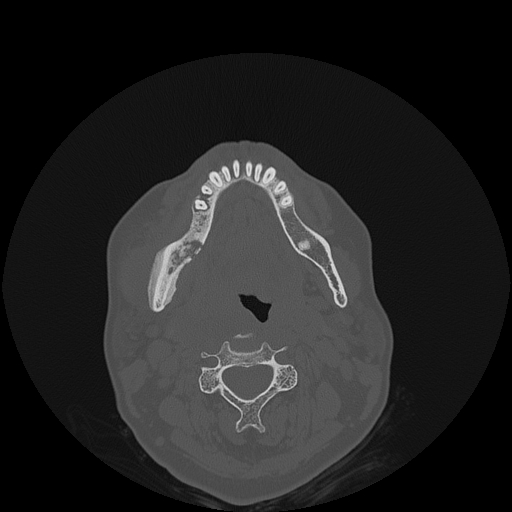 File:Bisphosphonate-related osteonecrosis of the jaw (Radiopaedia 71324-81642 Axial bone window 60).jpg