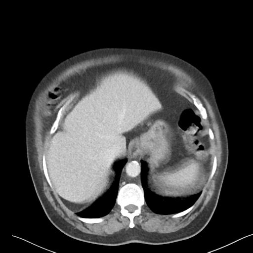File:Bladder papillary urothelial carcinoma (Radiopaedia 48119-52951 Axial 5).png