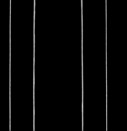 Blind-ending branch of a bifid ureter (Radiopaedia 61159-69048 C 77).jpg