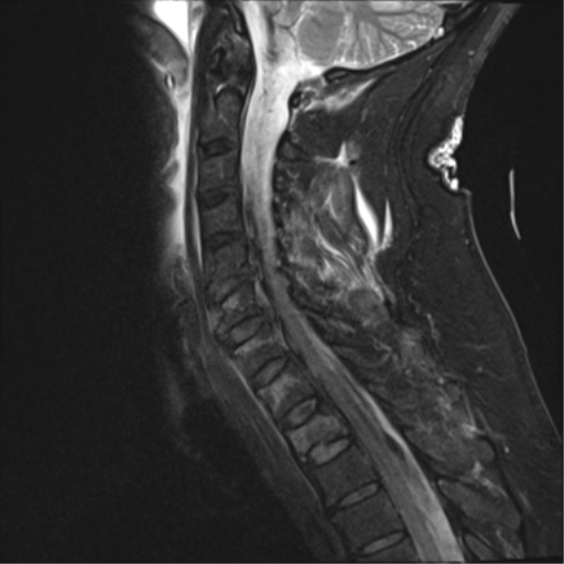 File:Blunt cerebrovascular injury (Radiopaedia 53682-59744 Sagittal T2 fat sat 6).png