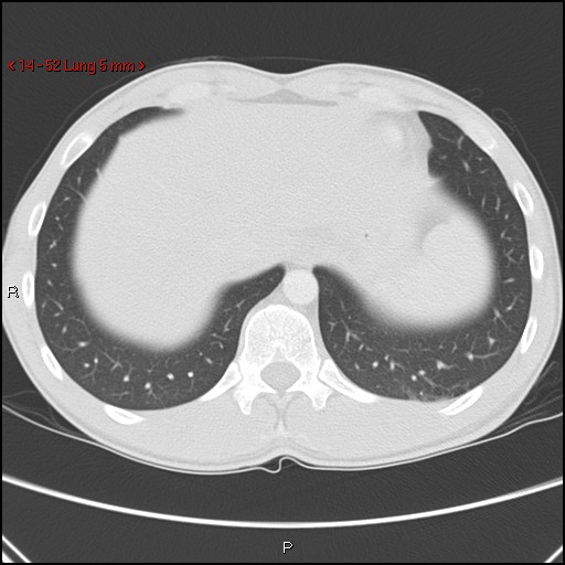 Blunt chest trauma - pulmonary interstitial emphysema and pneumomediastinum (Radiopaedia 20666-20552 Axial lung window 52).jpg