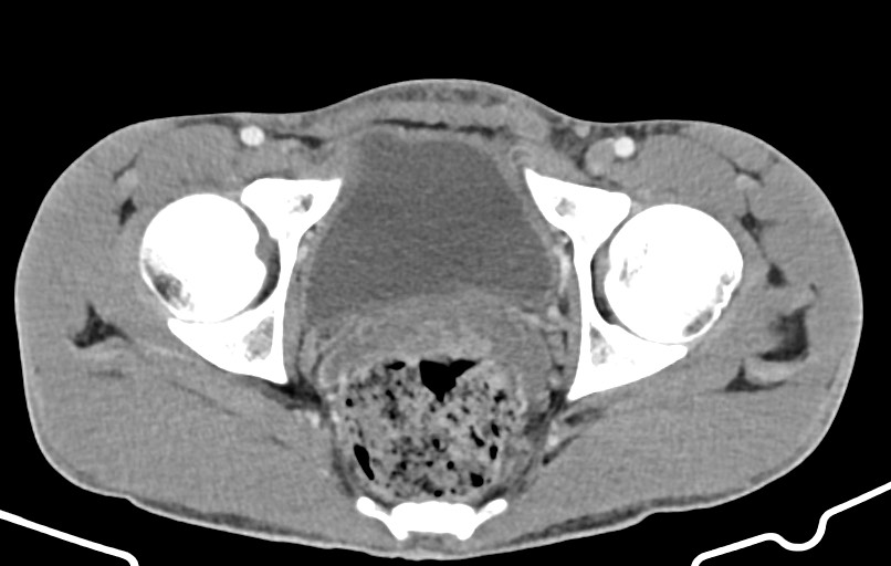 Blunt injury to the small bowel (Radiopaedia 74953-85987 A 182).jpg