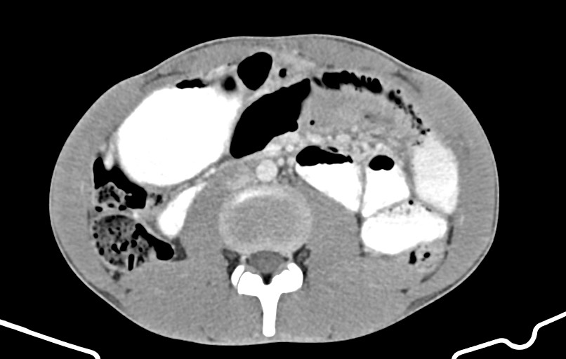 Blunt injury to the small bowel (Radiopaedia 74953-85987 A 90).jpg