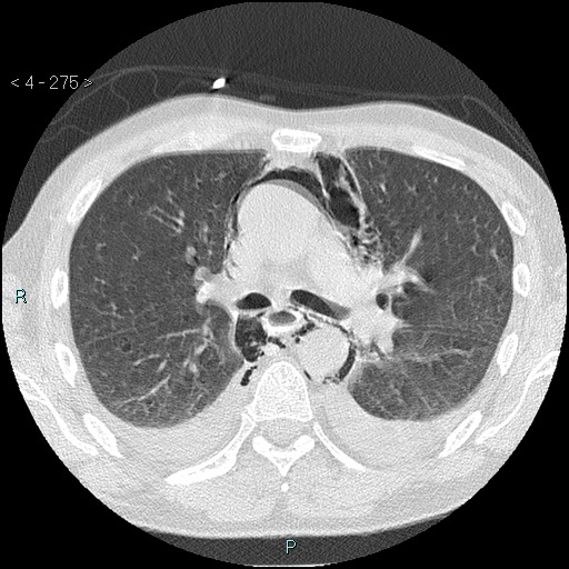 Boerhaave syndrome (Radiopaedia 27683-27897 lung window 28).jpg
