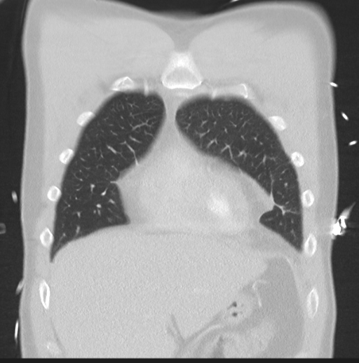 Boerhaave syndrome (Radiopaedia 39382-41661 Coronal lung window 11).png