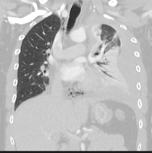 Boerhaave syndrome (Radiopaedia 39382-41661 Coronal lung window 23).png