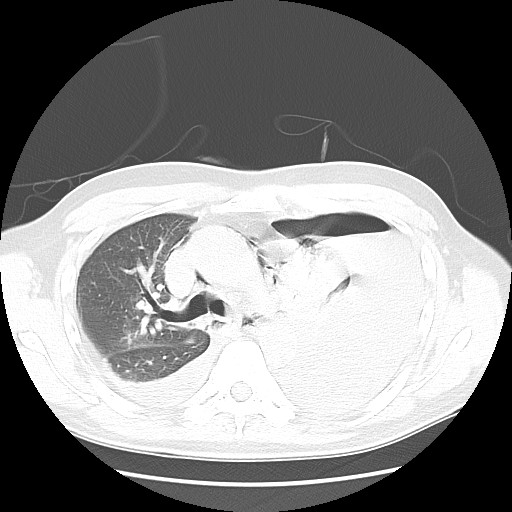 Boerhaave syndrome (Radiopaedia 59796-67310 Axial lung window 25).jpg