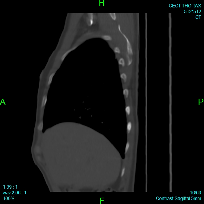 Bone metastases from lung carcinoma (Radiopaedia 54703-60937 Sagittal bone window 16).jpg