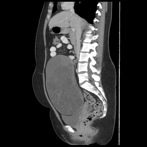 File:Borderline mucinous tumor (ovary) (Radiopaedia 78228-90808 B 33).jpg