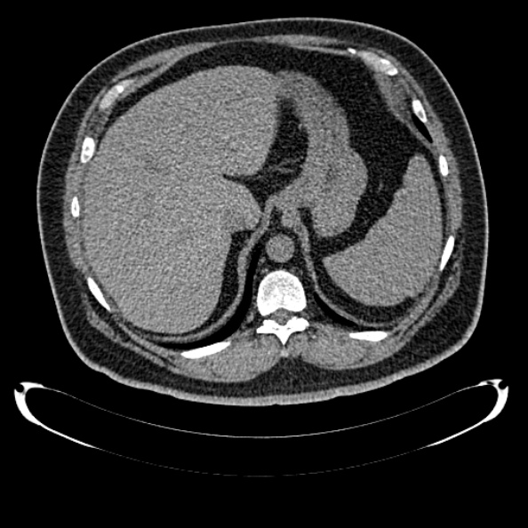 Bosniak renal cyst - type IV (Radiopaedia 24244-24518 Axial non-contrast 83).jpg