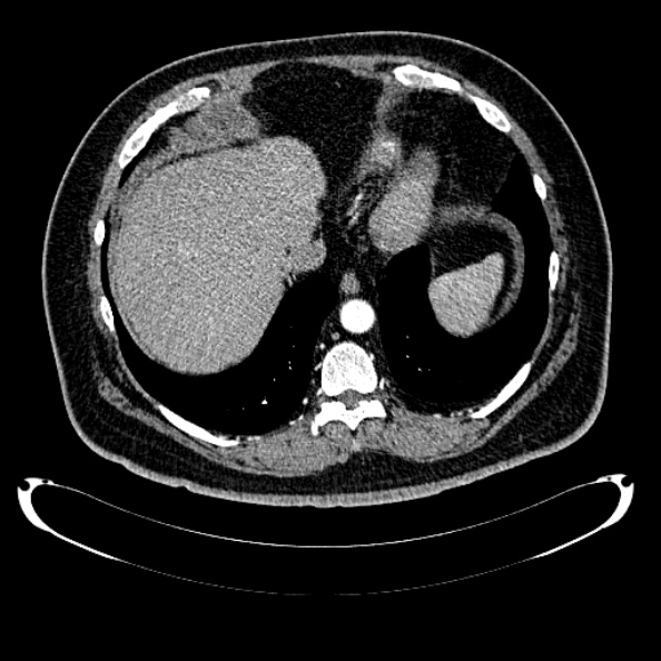 File:Bosniak renal cyst - type IV (Radiopaedia 24244-24518 B 28).jpg