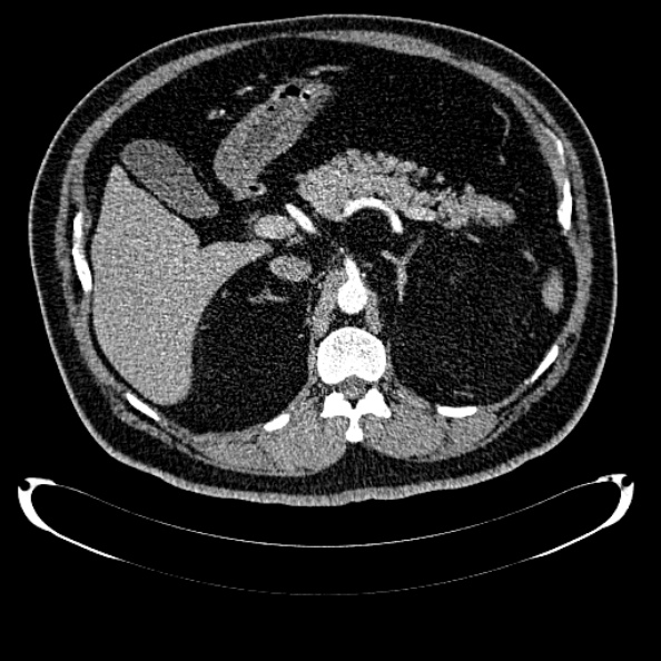 Bosniak renal cyst - type IV (Radiopaedia 24244-24518 B 98).jpg
