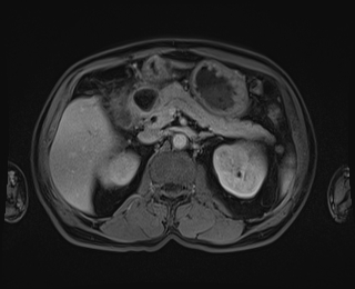 Bouveret syndrome (Radiopaedia 61017-68856 Axial T1 C+ fat sat 35).jpg