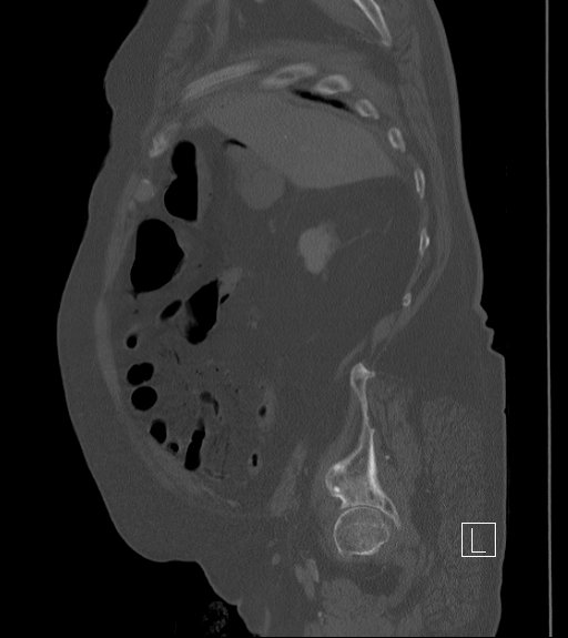 Bowel ischemia secondary to SMA occlusion with extensive portomesenteric venous gas (Radiopaedia 54656-60871 Sagittal bone window 90).jpg