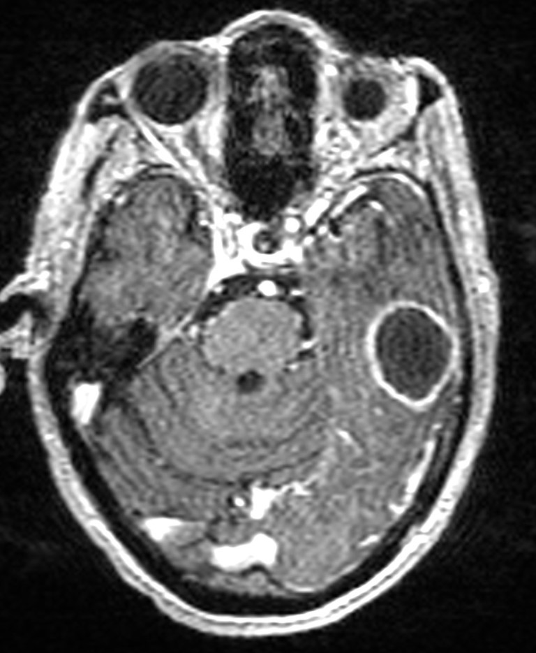 Brain abscess with dual rim sign (Radiopaedia 87566-103938 Axial T1 C+ 57).jpg