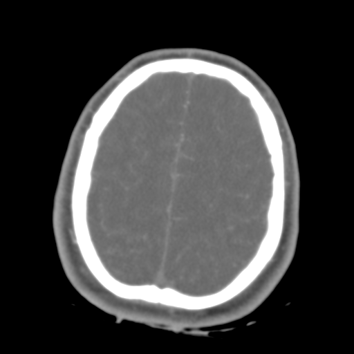 Brain contusions, internal carotid artery dissection and base of skull fracture (Radiopaedia 34089-35339 D 12).png