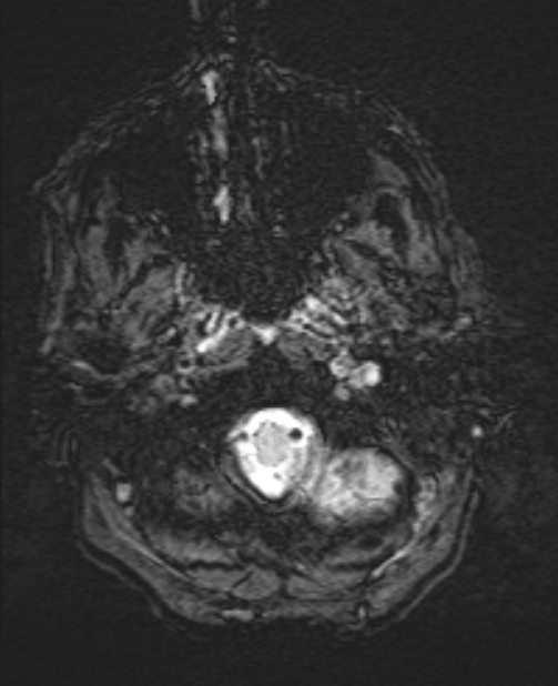 Brain metastases - lung cancer primary (Radiopaedia 75060-86115 Axial SWI 6).jpg