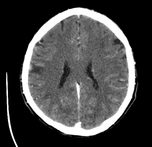 File:Brain metastases from lung cancer (Radiopaedia 24480-24781 Axial C+ delayed 39).jpg