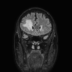 Brain metastases from lung cancer (Radiopaedia 83839-99028 Coronal FLAIR 20).jpg