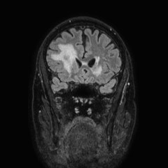Brain metastases from lung cancer (Radiopaedia 83839-99028 Coronal FLAIR 22).jpg