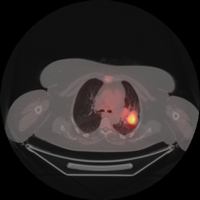 Brain metastasis (Radiopaedia 89847-106962 Axial lung window 20).jpg