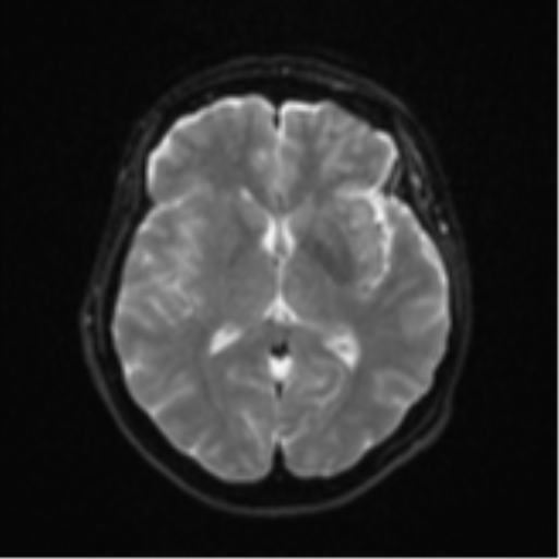 File:Brain metastasis (sarcoma) (Radiopaedia 47576-52209 Axial DWI 14).png