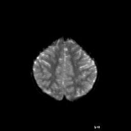 File:Brainstem ganglioglioma (Radiopaedia 10763-11224 Axial DWI 5).jpg