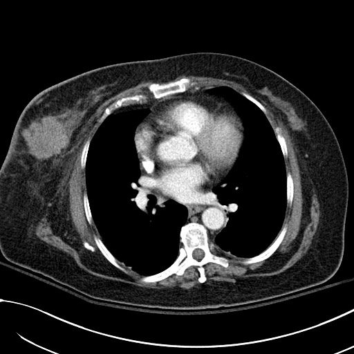 File:Breast carcinoma with pathological hip fracture (Radiopaedia 60314-67974 A 30).jpg