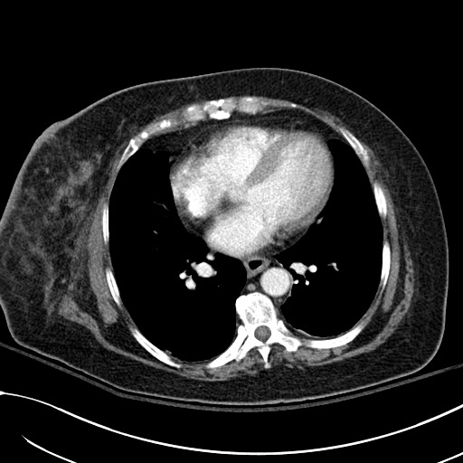 Breast carcinoma with pathological hip fracture (Radiopaedia 60314-67974 A 34).jpg
