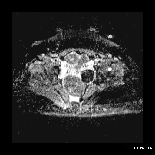 File:Broad ligament fibroid (Radiopaedia 49135-54241 Axial ADC 18).jpg