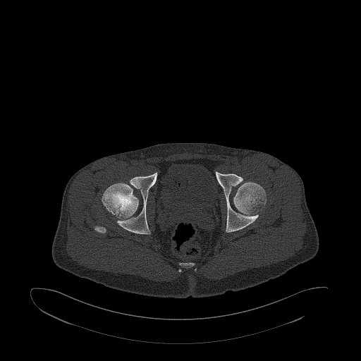 Brodie abscess- femoral neck (Radiopaedia 53862-59966 Axial bone window 144).jpg