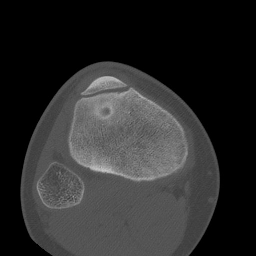 Brodie abscess of the tibia (Radiopaedia 58984-66250 Axial bone window 73).jpg