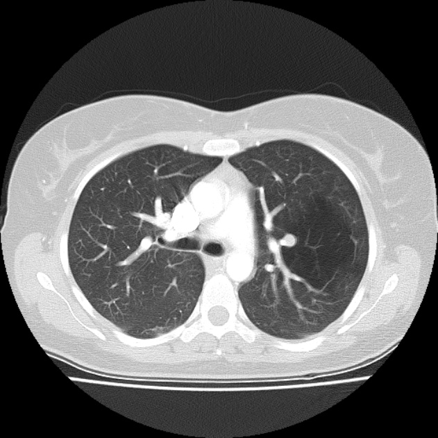 Bronchial atresia (Radiopaedia 22965-22992 Axial lung window 32).jpg