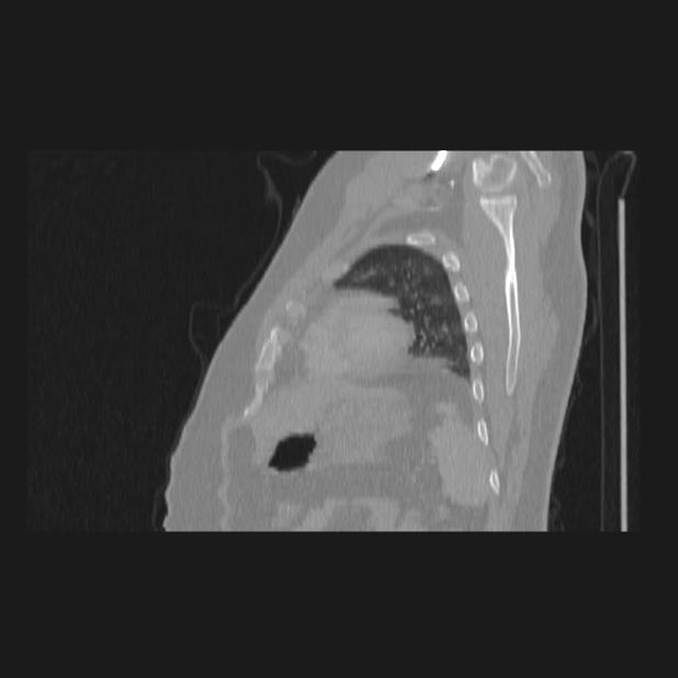 Bronchial atresia (Radiopaedia 60685-68439 Sagittal lung window 78).jpg