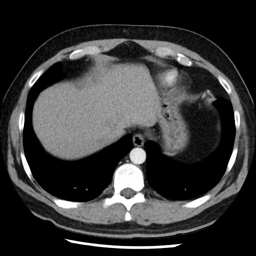 Bronchial carcinoid tumor (Radiopaedia 67377-76764 A 50).jpg