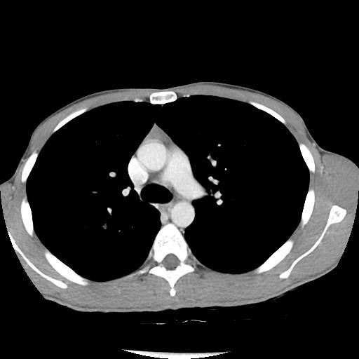 Bronchial carcinoid tumor causing right lower lobe collapse (Radiopaedia 83495-98594 A 18).jpg