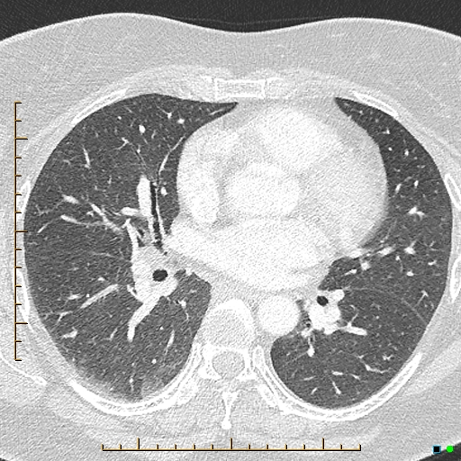 Bronchial diverticula (Radiopaedia 79512-92676 Axial lung window 105).jpg