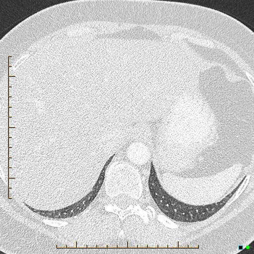 Bronchial diverticula (Radiopaedia 79512-92676 Axial lung window 191).jpg