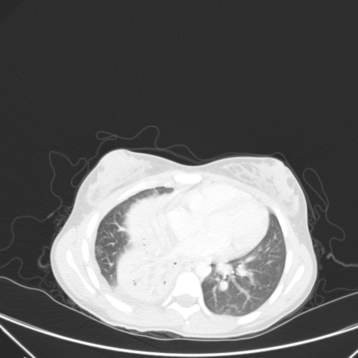 Bronchial mucoepidermoid carcinoma (Radiopaedia 57023-63895 Axial lung window 68).jpg