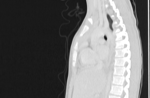 Bronchial mucoepidermoid carcinoma (Radiopaedia 57023-63895 Sagittal lung window 92).jpg
